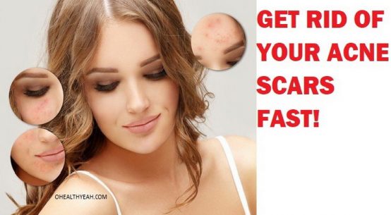woman with acne scars logo