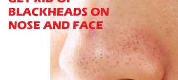 blackheads on nose