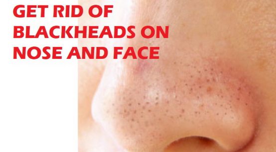 blackheads on nose