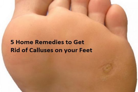 calluses on feet picture