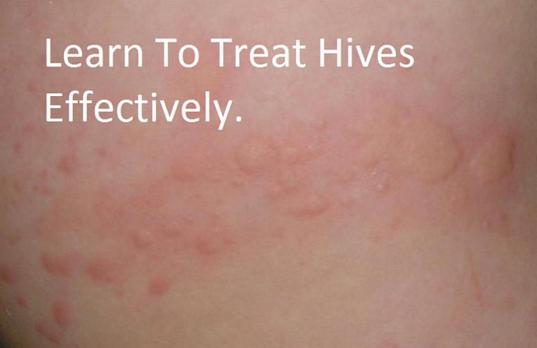 hives on white skin
