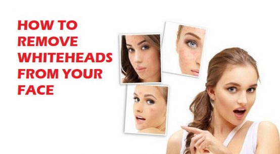 get rid of whiteheads on face and nose